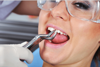 Teeth-Extraction-Dental-treatments-https://lylaclinic.com/