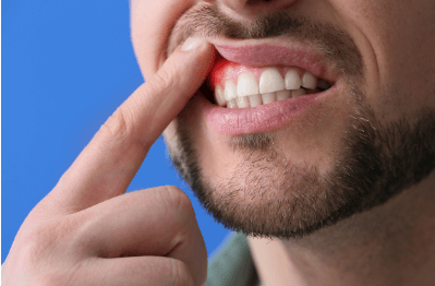 Periodontal-Disease-Dental-treatments-https://lylaclinic.com/